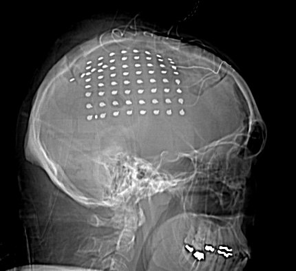 CT Scan of electrode array